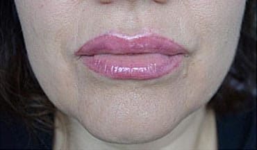 Cosmetic tattoo lip after