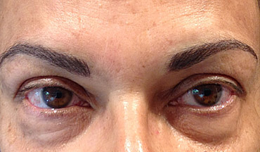 Cosmetic tattoo hair stroke brows a before